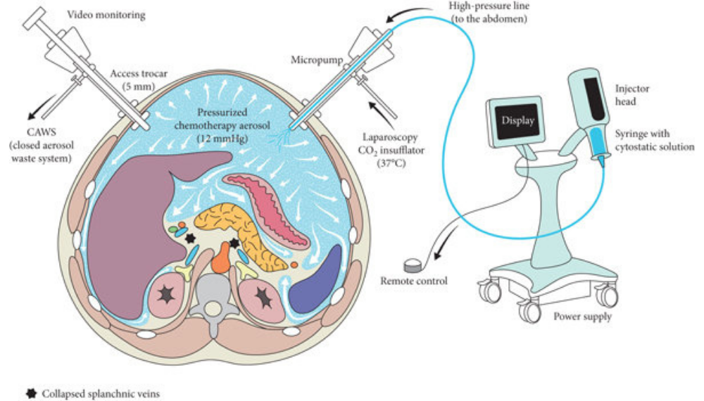 Per pazienti con metastasi peritoneale da tumore del pancreas un trattamento innovativo e mini invasivo